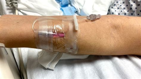 IV Infiltration and Extravasation Causes and Prevention | Vascular Wellness
