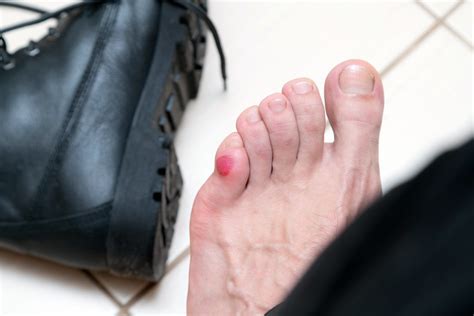 Blisters | Foot | Foot Doctor | Foot Pain | Marion County | Sumter County