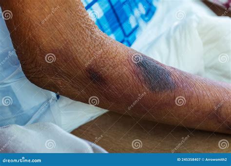 Bruises From Blood Collection Isolated On White Background. Royalty ...