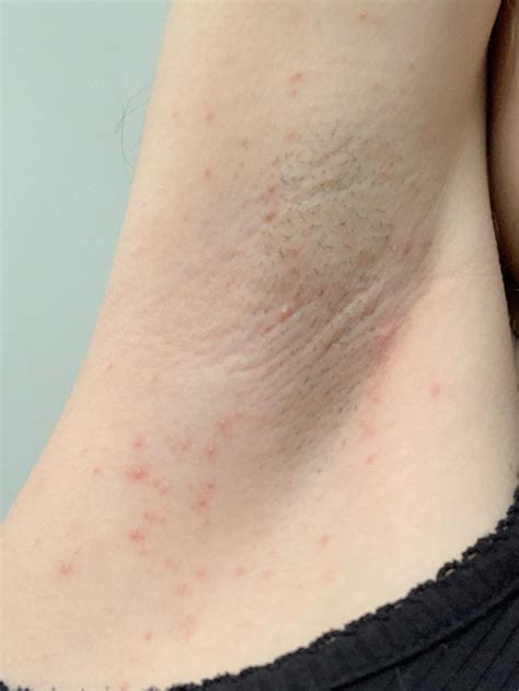 Deodorant Armpit Rash Causes Understanding Deodorant Allergy And How