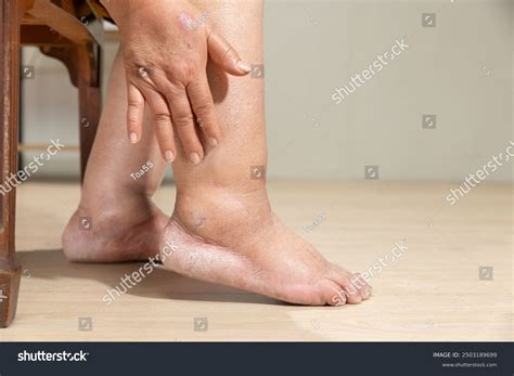 Womans Leg Edema Swelling After Cancer Stock Photo 2503189699 ...