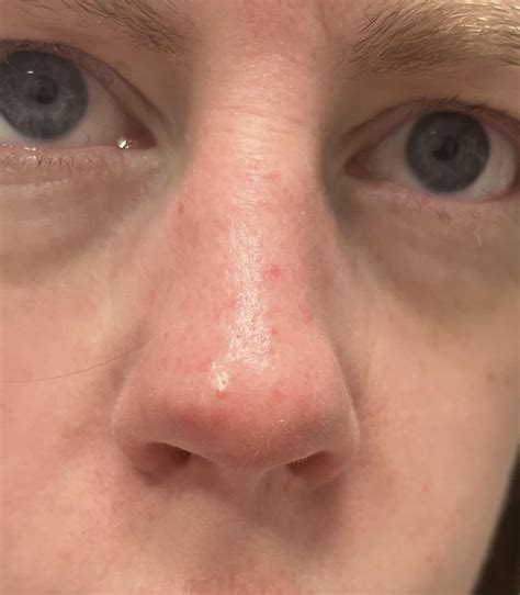 Red bumps appearing on nose: any idea what these are and what to do about them? : r ...