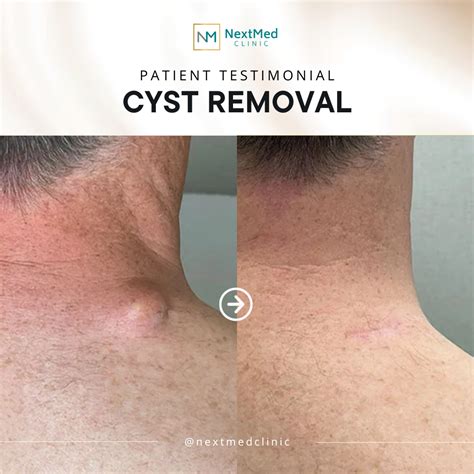 Cyst Cyst Removal