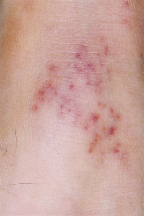 Neck Rash Causes and How to Treat and Prevent It