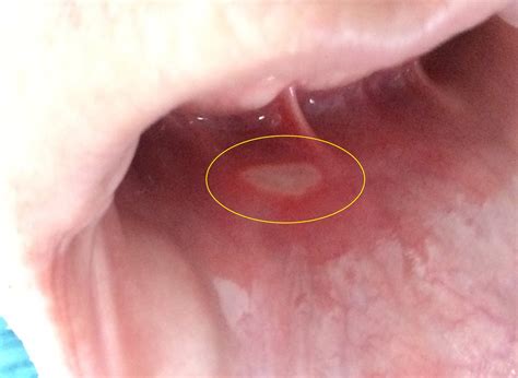 Soft Palate Canker Sore