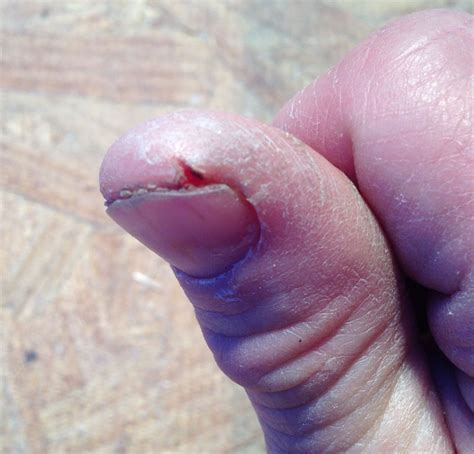 Sandpaper hands? How to fix dry cracked hands fast