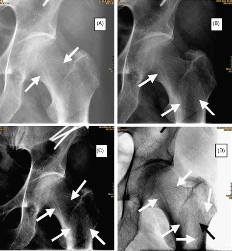 Evaluation of Singh index for assessment of osteoporosis using digital radiography - European ...