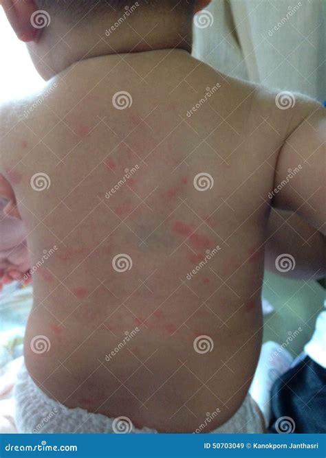 Face Hives Baby at Molly Nielsen blog