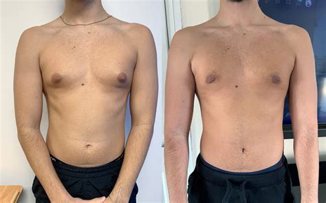 Gynecomastia – Dr Carlo Debbas