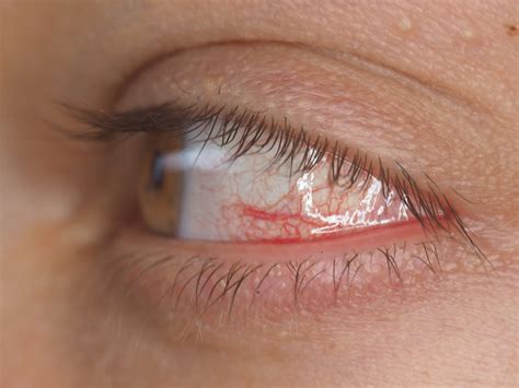 Corneal Abrasion - Treatment, Causes and Symptoms