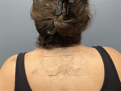 Plastic Surgery Case Study - Webbed Neck Correction with Buffalo Hump ...