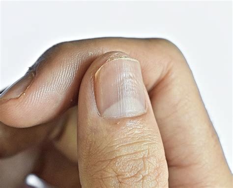 What do vertical ridges on fingernails mean – Artofit