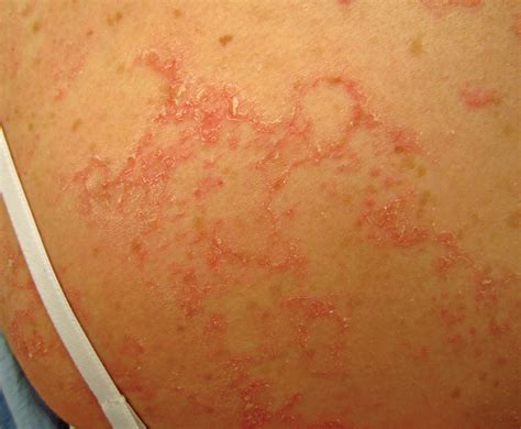 Itchy Rash With Diarrhea at Gemma Hoff blog
