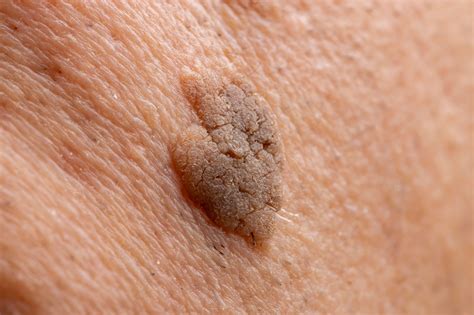 Seborrheic Keratosis Removal Glasgow | Waverley Park Medical Practice