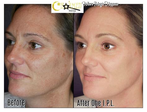 Ipl Light Therapy Before And After at Kristen Millett blog