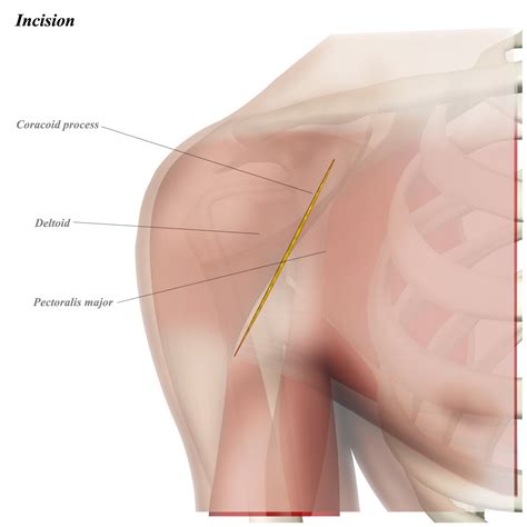 Retraction Medical Terminology Definition at Maria Spillman blog