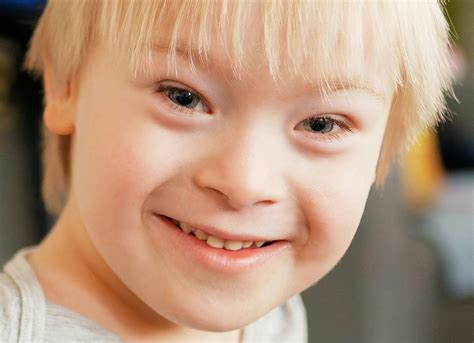 Almond Shaped Eyes In Down Syndrome at Sarah Plank blog