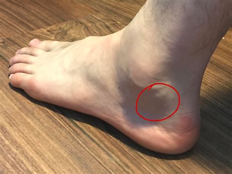 Pain and hardened lump on left ankle : r/FootFunction