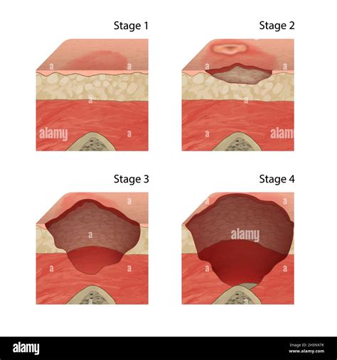 Pressure Stages Of Bed Sores at Blake Corlis blog
