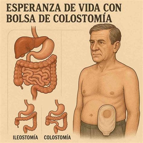 Esperanza de vida con bolsa de colostomía | ¡Las ostomías hoy!