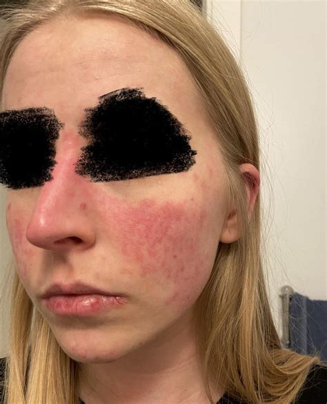 Why is my face burning at night? : r/DermatologyQuestions