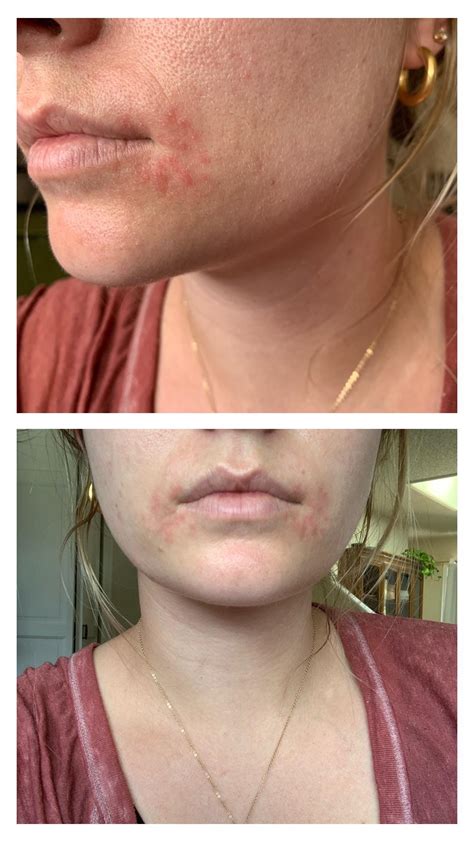 [Skin Concerns] Red/bumpy/flaky skin on either side of my mouth just popped up, anyone ever ...