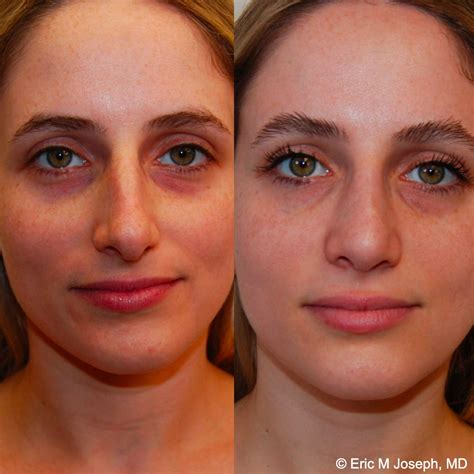 Eric M. Joseph, MD | Rhinoplasty Before & After Photos