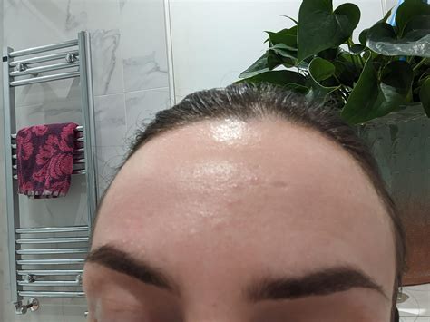 What are these bumps on my forehead? And how can I get rid of them? : r/SkincareAddicts