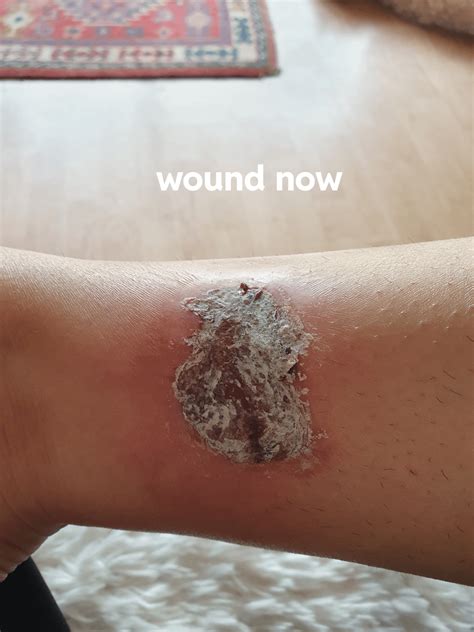 White scab on wound : r/woundcare