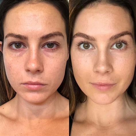 Breast Implant Illness Everything You Need To Know