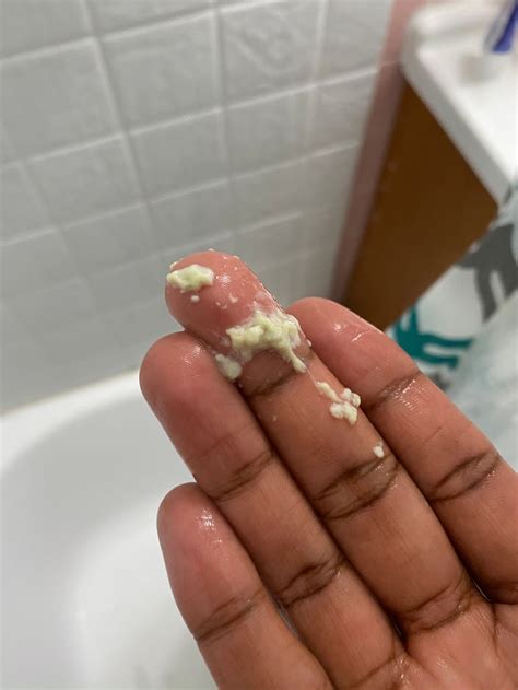 Yeast Infection Secretion