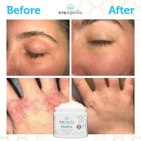 Crema Para Eczema Psoriasis Comezón Piel Seca Avena Coloidal Manzanilla NUEVO | eBay