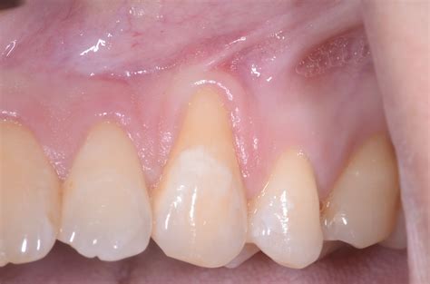 What Is Gum.grafting at Roberta Warren blog