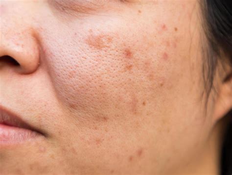 Problems facial skin is acne and blemishes. 7426688 Stock Photo at Vecteezy