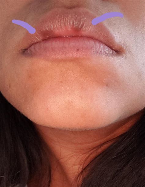 What are these pinkish bumps? I've been working on getting them more ...