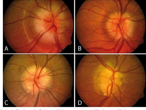 Optic Disc Drusen