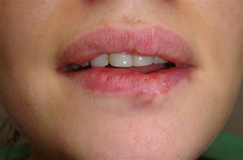 Bacterial Infection On Lips