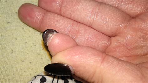 Fingernail Skin Peeling