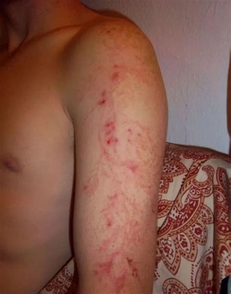 Incredible photos reveal what happens to your SKIN if you're struck by ...