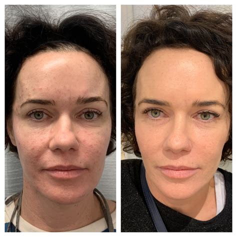 PRP Treatments | Austin Regenerative Therapy