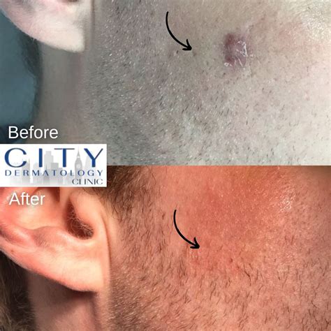 Before & After Photos Cyst Removal