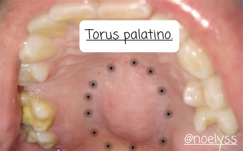 What Is Palatal Torus at Lisette Webb blog