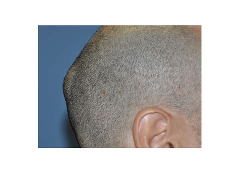 Case Study: Removal of Skull Lumps and Bumps (Osteomas) - Explore Plastic Surgery