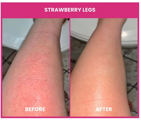 Exfoliating Strawberry Legs Before And After at James Browning blog