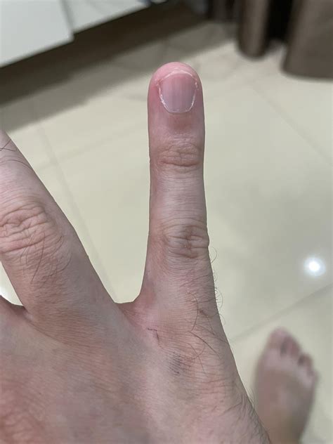 Scabies ink test over a few days - Thoughts? It seems to be changing ...