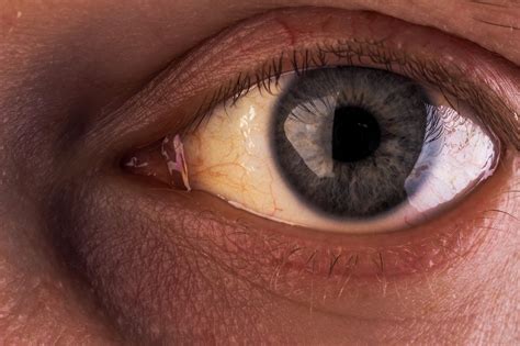 Yellow Eyes: Common Causes and When to See a Doctor