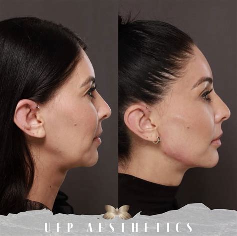 Can Dermal Fillers Get Rid Of My Jowls? - Utah Facial Plastics