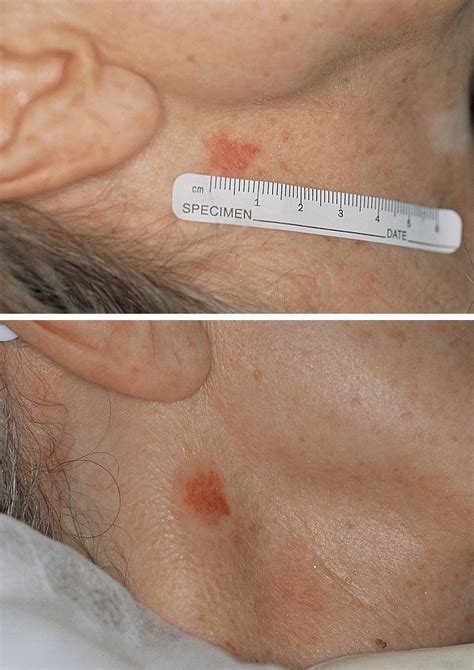 Basal Cell Carcinoma Jaw at Dolores Leddy blog