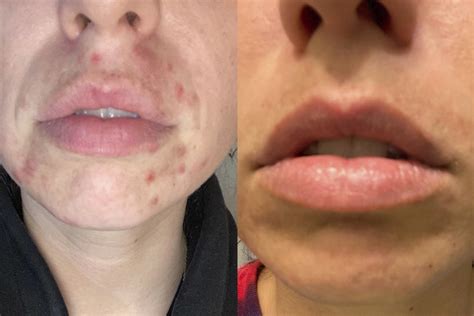 Stress Acne On Lips - Infoupdate.org