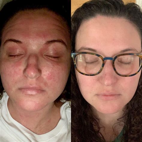 How Fast Does Dupixent Work
